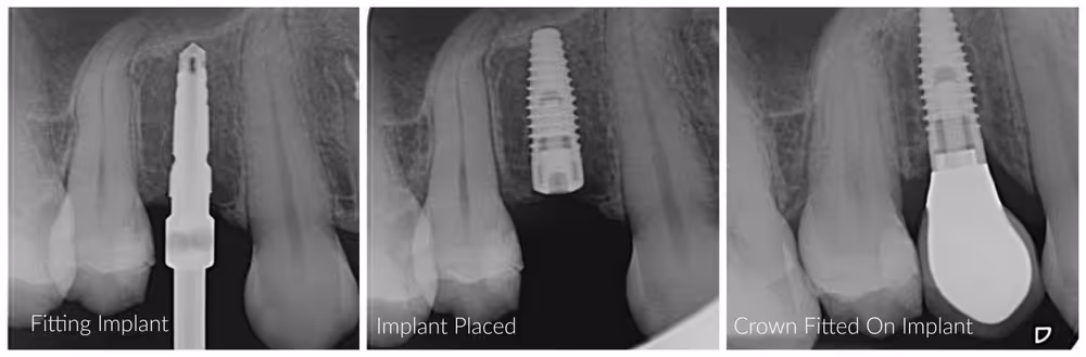 stages of tooth implant procedure